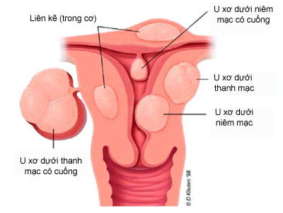 Những triệu chứng u xơ tử cung điển hình