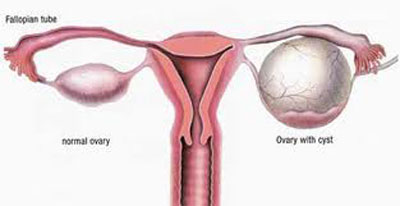bệnh viêm buồng trứng ở phụ nữ