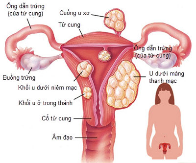 4 cách chữa bệnh u xơ tử cung